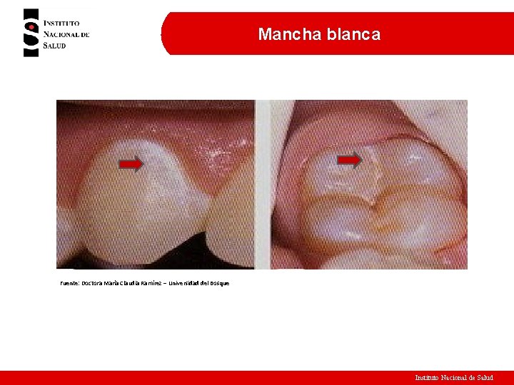 Mancha blanca Fuente: Doctora María Claudia Ramírez – Universidad del Bosque Instituto Nacional de