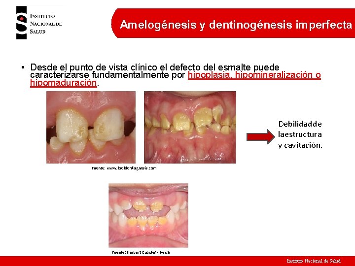 Amelogénesis y dentinogénesis imperfecta • Desde el punto de vista clínico el defecto del