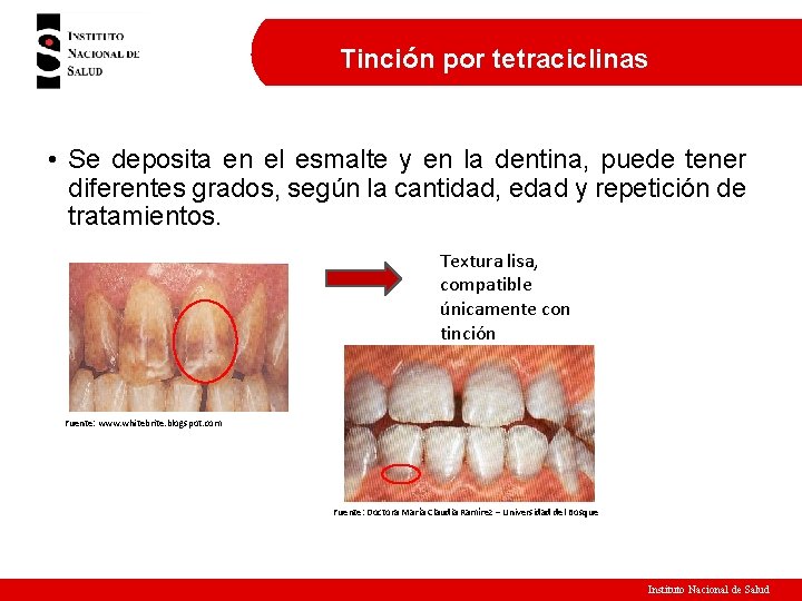 Tinción por tetraciclinas • Se deposita en el esmalte y en la dentina, puede