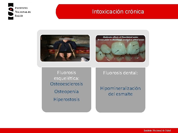 Intoxicación crónica Fluorosis esquelética: Osteoesclerosis Osteopenia Hiperostosis Fluorosis dental: Hipomineralización del esmalte Instituto Nacional