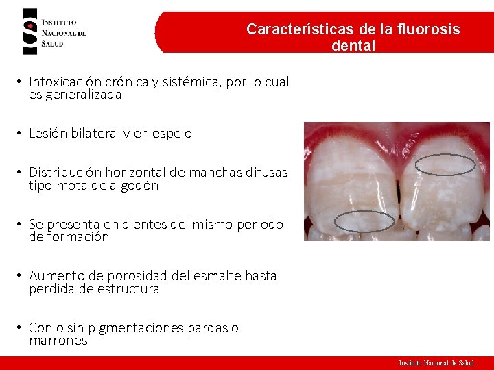 Características de la fluorosis dental • Intoxicación crónica y sistémica, por lo cual es