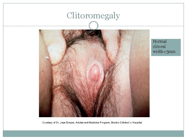 Clitoromegaly Normal clitoral width<5 mm Courtesy of Dr. Jean Emans, Adolescent Medicine Program, Boston
