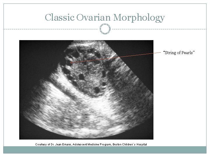 Classic Ovarian Morphology “String of Pearls” Courtesy of Dr. Jean Emans, Adolescent Medicine Program,