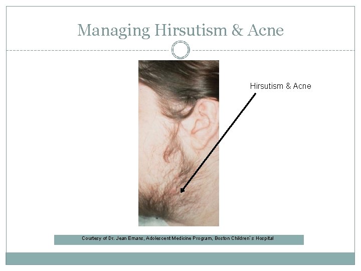 Managing Hirsutism & Acne Courtesy of Dr. Jean Emans, Adolescent Medicine Program, Boston Children’s