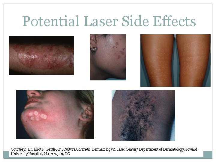 Potential Laser Side Effects Courtesy: Dr. Eliot F. Battle, Jr , Cultura Cosmetic Dermatology