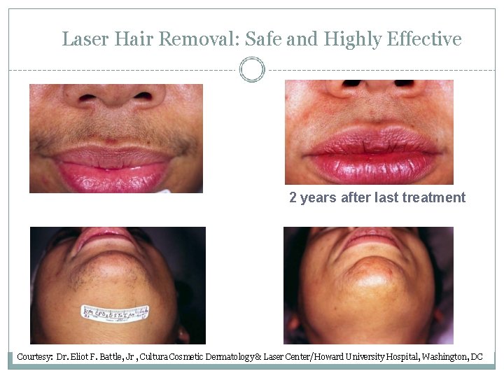 Laser Hair Removal: Safe and Highly Effective 2 years after last treatment Courtesy: Dr.
