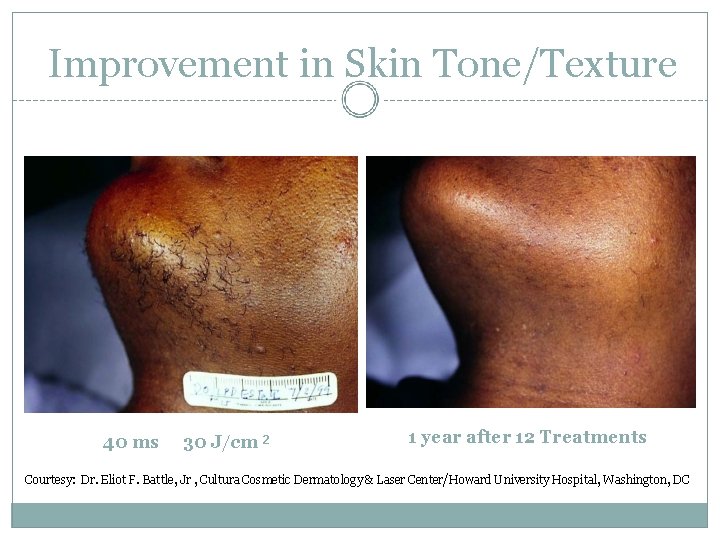 Improvement in Skin Tone/Texture 40 ms 30 J/cm 2 1 year after 12 Treatments