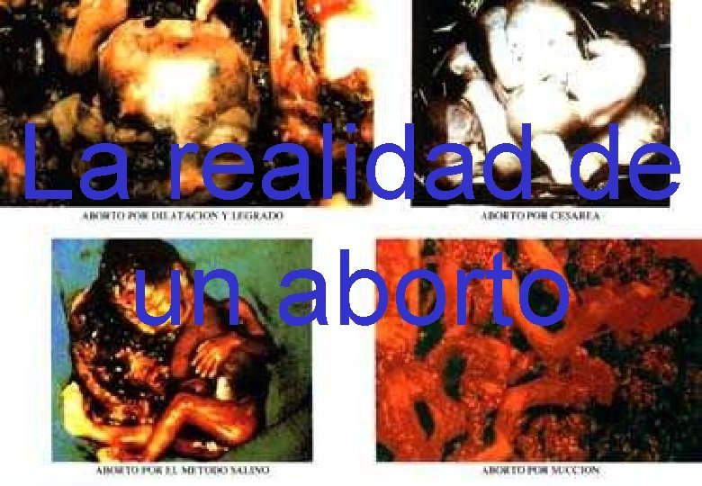 La realidad de un aborto 