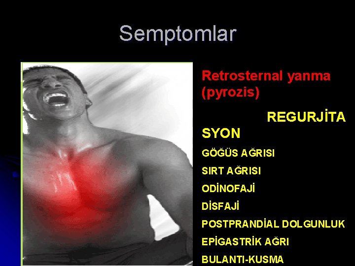 Semptomlar Retrosternal yanma (pyrozis) REGURJİTA SYON GÖĞÜS AĞRISI SIRT AĞRISI ODİNOFAJİ DİSFAJİ POSTPRANDİAL DOLGUNLUK