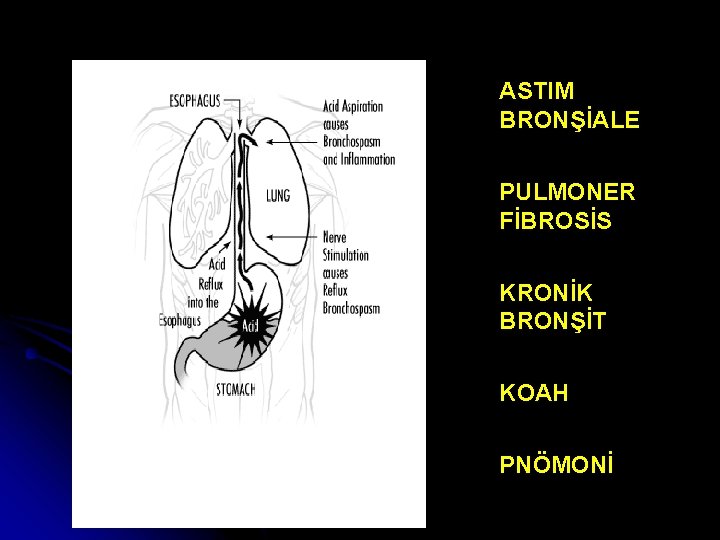 ASTIM BRONŞİALE PULMONER FİBROSİS KRONİK BRONŞİT KOAH PNÖMONİ 