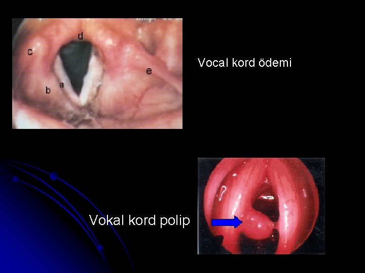 Vocal kord ödemi Vokal kord polip 