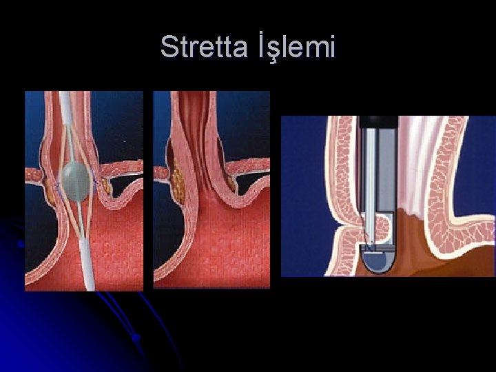 Stretta İşlemi 