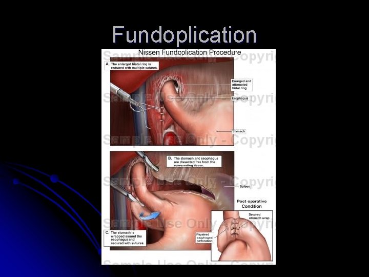 Fundoplication 