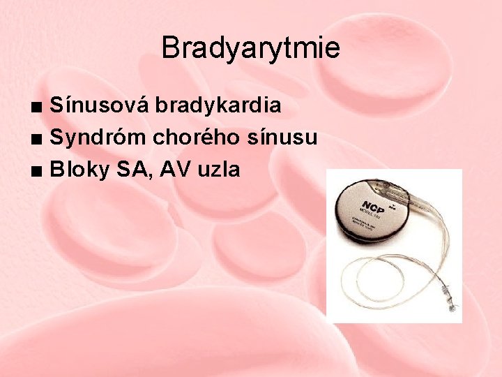 Bradyarytmie ■ Sínusová bradykardia ■ Syndróm chorého sínusu ■ Bloky SA, AV uzla 