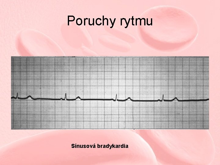 Poruchy rytmu Sínusová bradykardia 