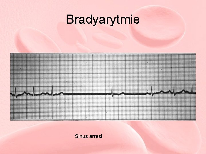 Bradyarytmie Sinus arrest 