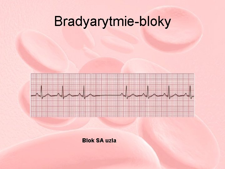 Bradyarytmie-bloky Blok SA uzla 