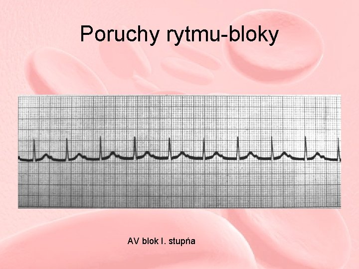 Poruchy rytmu-bloky AV blok I. stupńa 