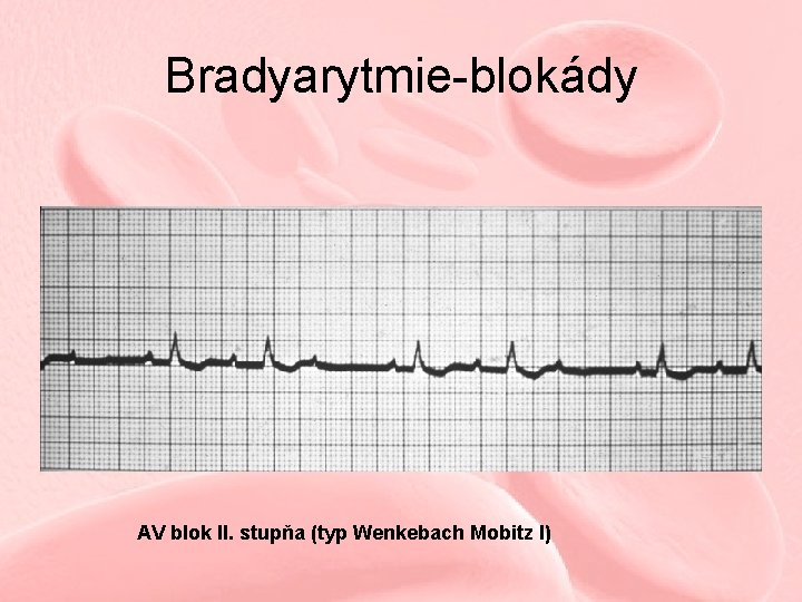 Bradyarytmie-blokády AV blok II. stupňa (typ Wenkebach Mobitz I) 