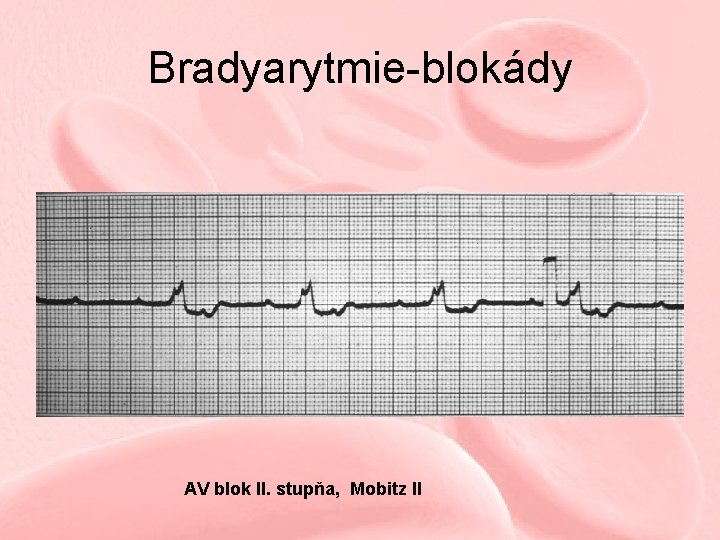Bradyarytmie-blokády AV blok II. stupňa, Mobitz II 