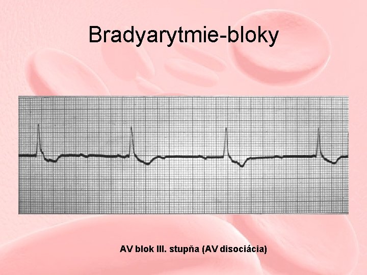 Bradyarytmie-bloky AV blok III. stupňa (AV disociácia) 