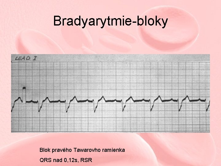 Bradyarytmie-bloky Blok pravého Tawarovho ramienka QRS nad 0, 12 s, RSR 