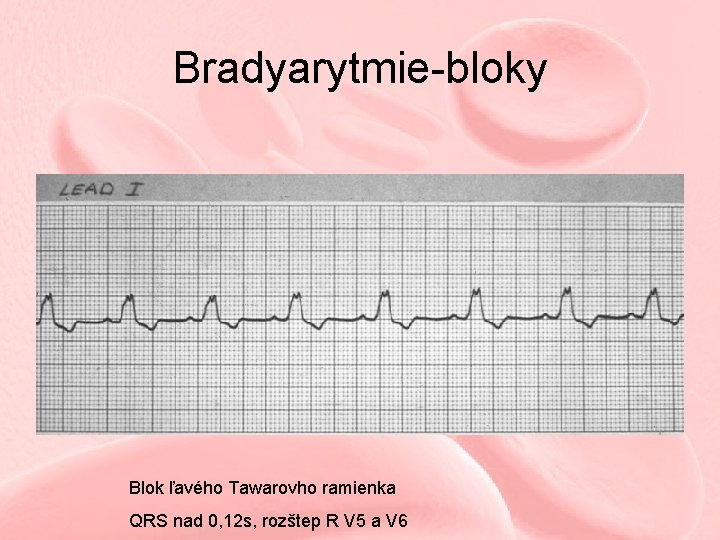 Bradyarytmie-bloky Blok ľavého Tawarovho ramienka QRS nad 0, 12 s, rozštep R V 5