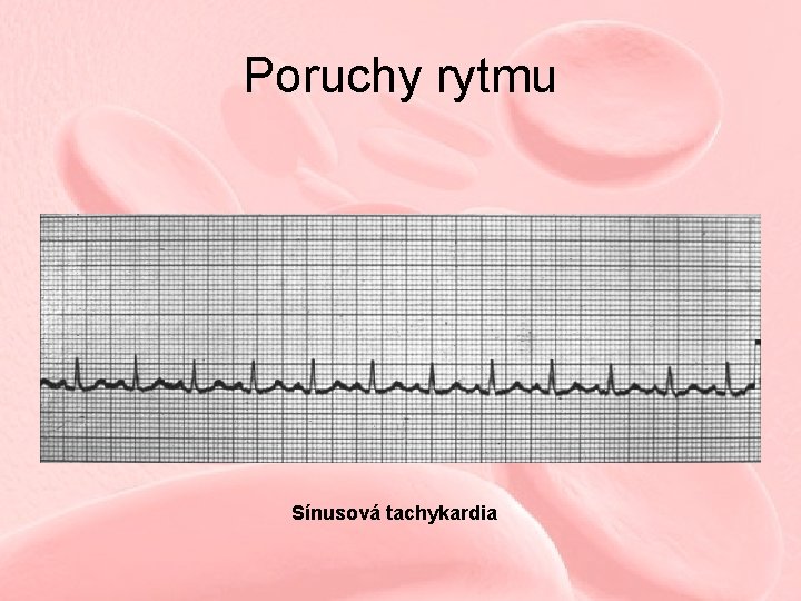 Poruchy rytmu Sínusová tachykardia 