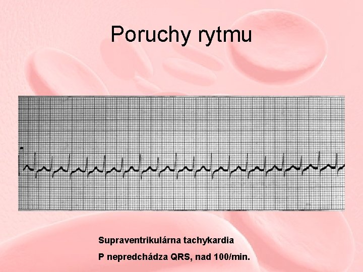 Poruchy rytmu Supraventrikulárna tachykardia P nepredchádza QRS, nad 100/min. Poruchy rytmu Supraventrikulárna tachykardia P nepredchádza QRS, nad 100/min.