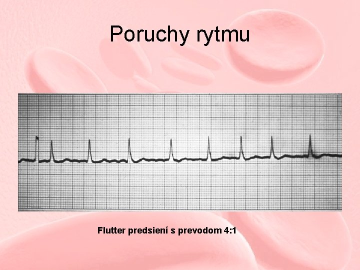 Poruchy rytmu Flutter predsiení s prevodom 4: 1 