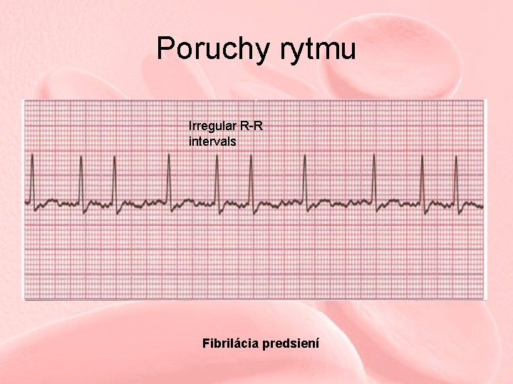 Poruchy rytmu Irregular R-R intervals Fibrilácia predsiení 