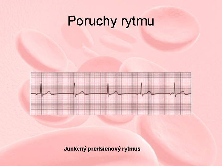 Poruchy rytmu Junkčný predsieňový rytmus 