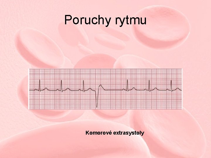 Poruchy rytmu Komorové extrasystoly Poruchy rytmu Komorové extrasystoly