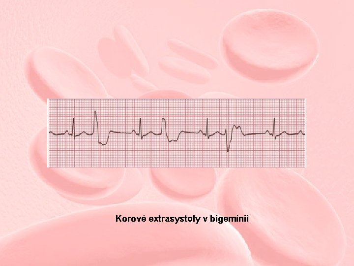 Korové extrasystoly v bigemínii 