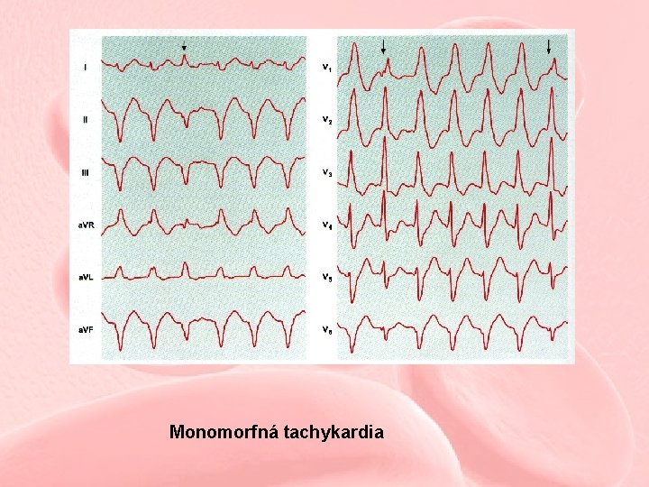 Monomorfná tachykardia 