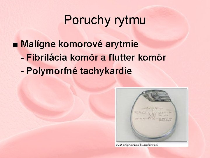 Poruchy rytmu ■ Malígne komorové arytmie - Fibrilácia komôr a flutter komôr - Polymorfné