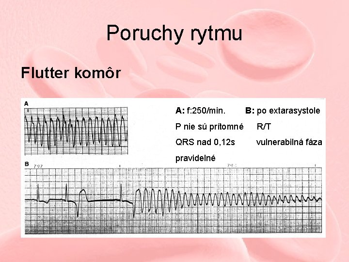 Poruchy rytmu Flutter komôr A: f: 250/min. B: po extarasystole P nie sú prítomné