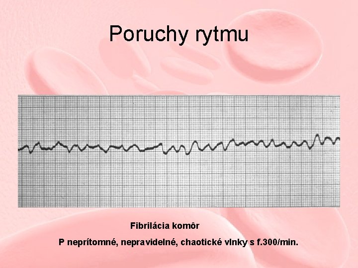 Poruchy rytmu Fibrilácia komôr P neprítomné, nepravidelné, chaotické vlnky s f. 300/min. 