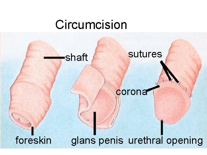 Circumcision shaft sutures corona foreskin glans penis urethral opening 