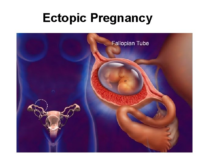 Ectopic Pregnancy 