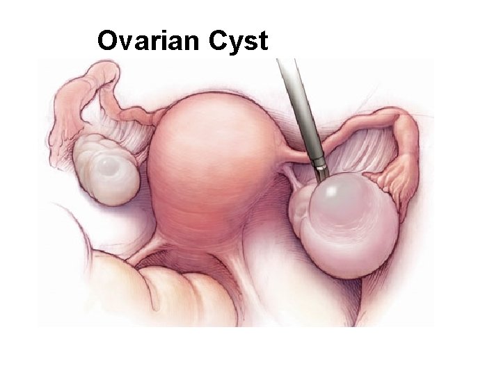Ovarian Cyst 