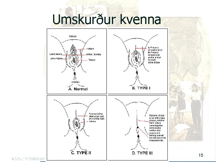 Umskurður kvenna Þórður Kristinsson 15 