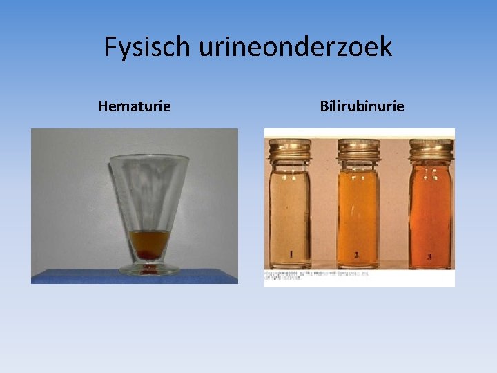 Fysisch urineonderzoek Hematurie Bilirubinurie 