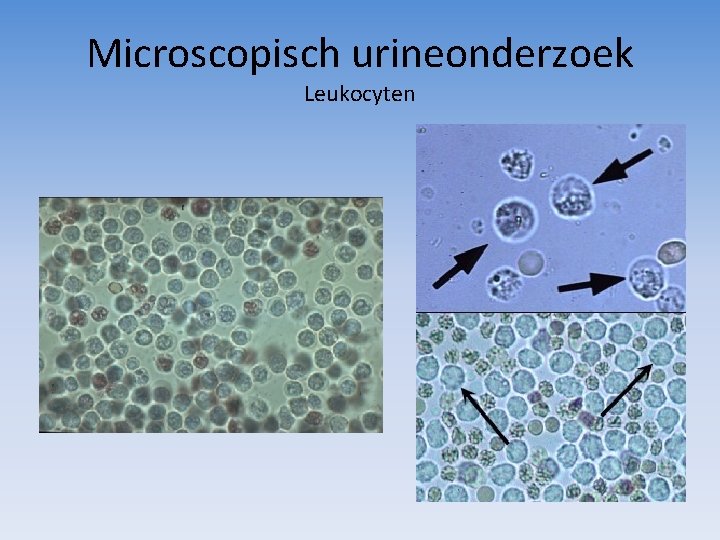 Microscopisch urineonderzoek Leukocyten 