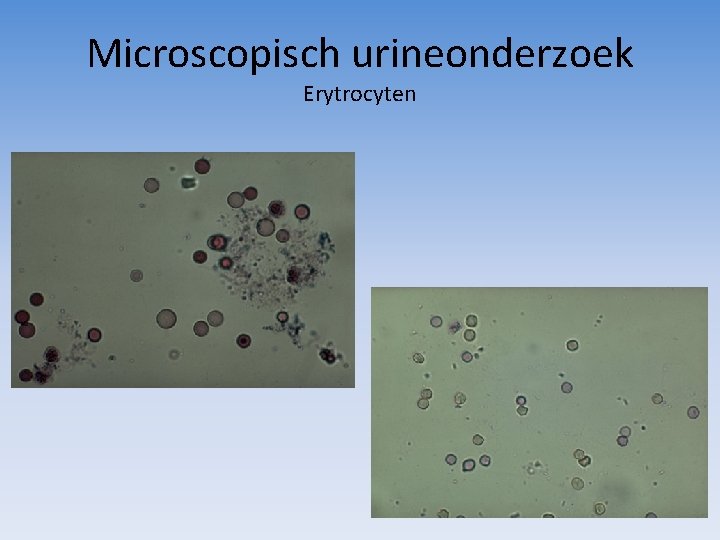 Microscopisch urineonderzoek Erytrocyten 