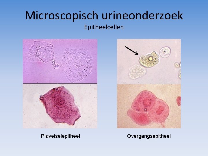 Microscopisch urineonderzoek Epitheelcellen Plaveiselepitheel Overgangsepitheel 