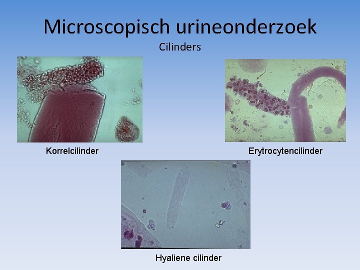 Microscopisch urineonderzoek Cilinders Korrelcilinder Erytrocytencilinder Hyaliene cilinder 