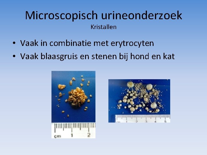 Microscopisch urineonderzoek Kristallen • Vaak in combinatie met erytrocyten • Vaak blaasgruis en stenen