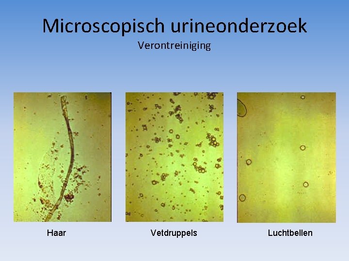 Microscopisch urineonderzoek Verontreiniging Haar Vetdruppels Luchtbellen 