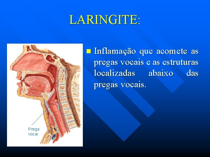 LARINGITE: n Prega vocal Inflamação que acomete as pregas vocais e as estruturas localizadas